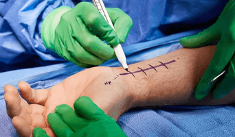 Hand Surgery