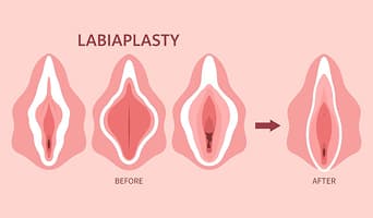 Labiaplasty