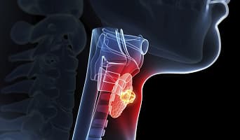 Larynx Cancer Treatment