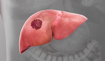 Liver Cancer
