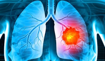 Lung Cancer