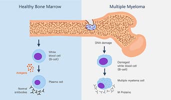 Multiple Myeloma (MM)