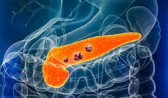 Pancreatic Cancer