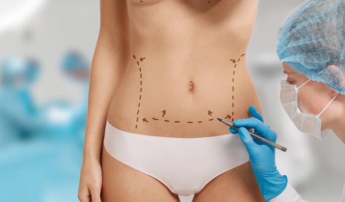 Panniculectomy
