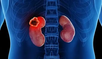 Renal Cancer Treatment