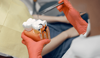 Root Canal