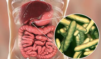Whipple Surgery (Pancreaticoduodenectomy)