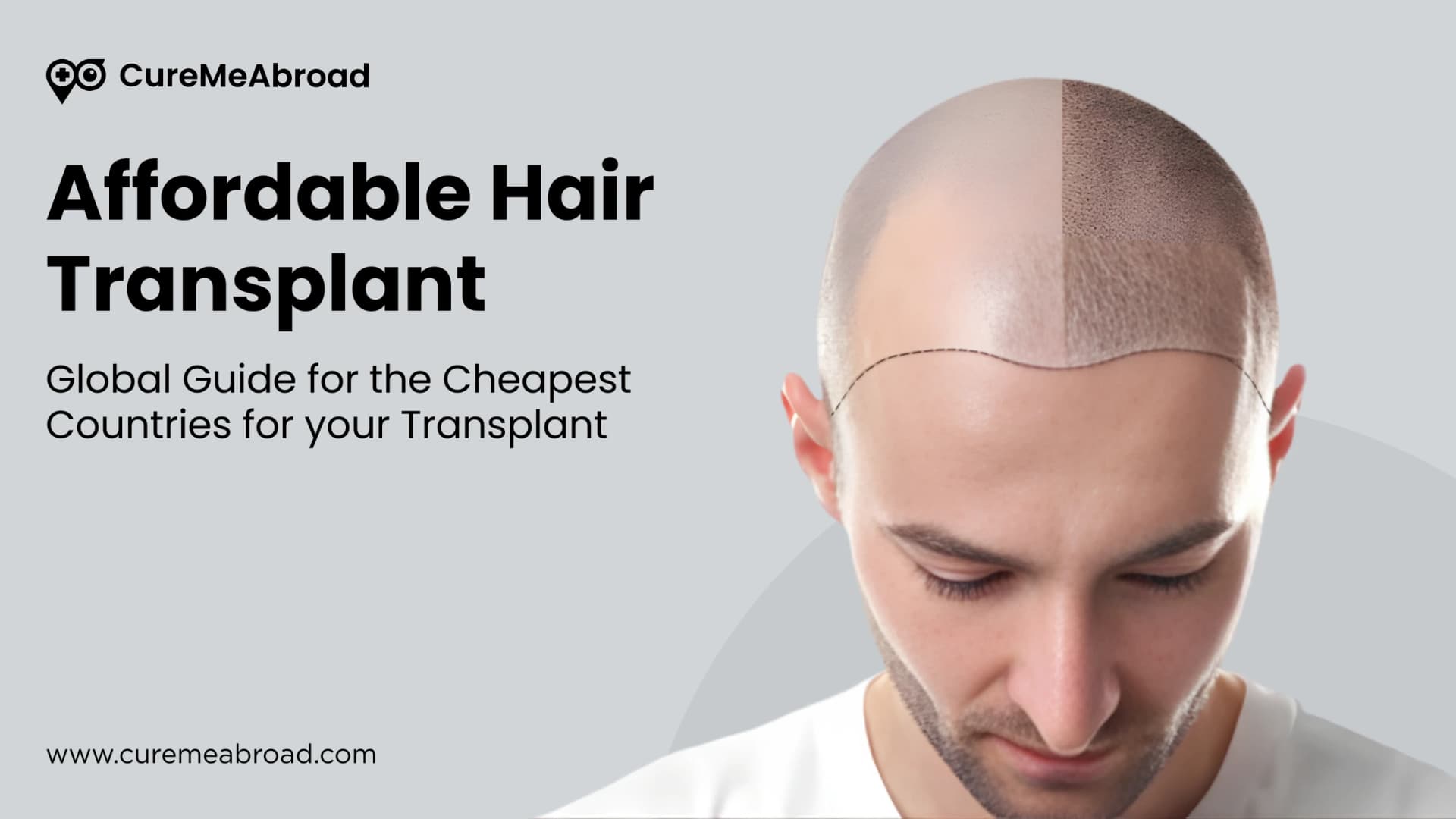 Affordable Hair Transplant: Global Guide for the Cheapest Countries for Your Transplant