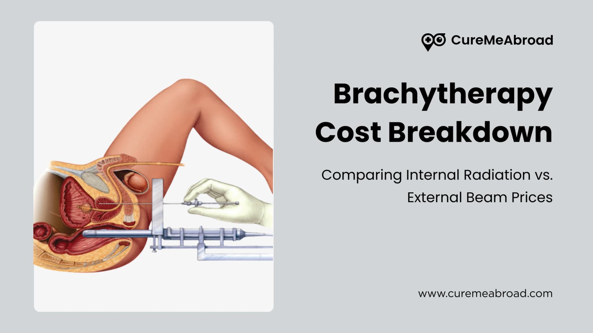 Brachytherapy Cost Breakdown: Comparing Internal Radiation vs. External Beam Prices