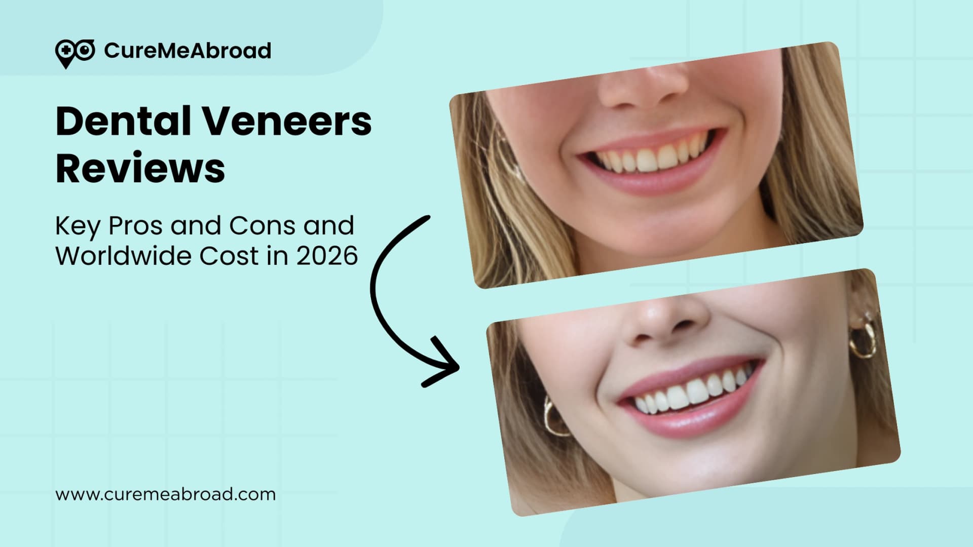Dental Veneers Reviews: Key Pros and Cons and Worldwide Cost in 2026