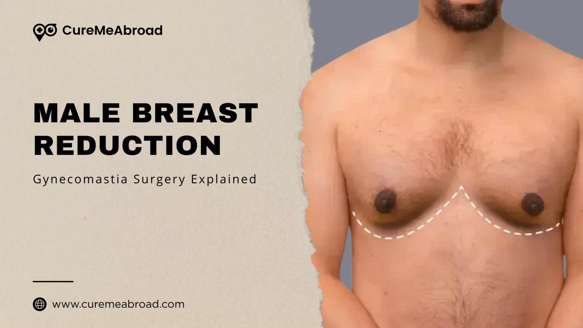 Male Breast Reduction: Gynecomastia Surgery Explained
