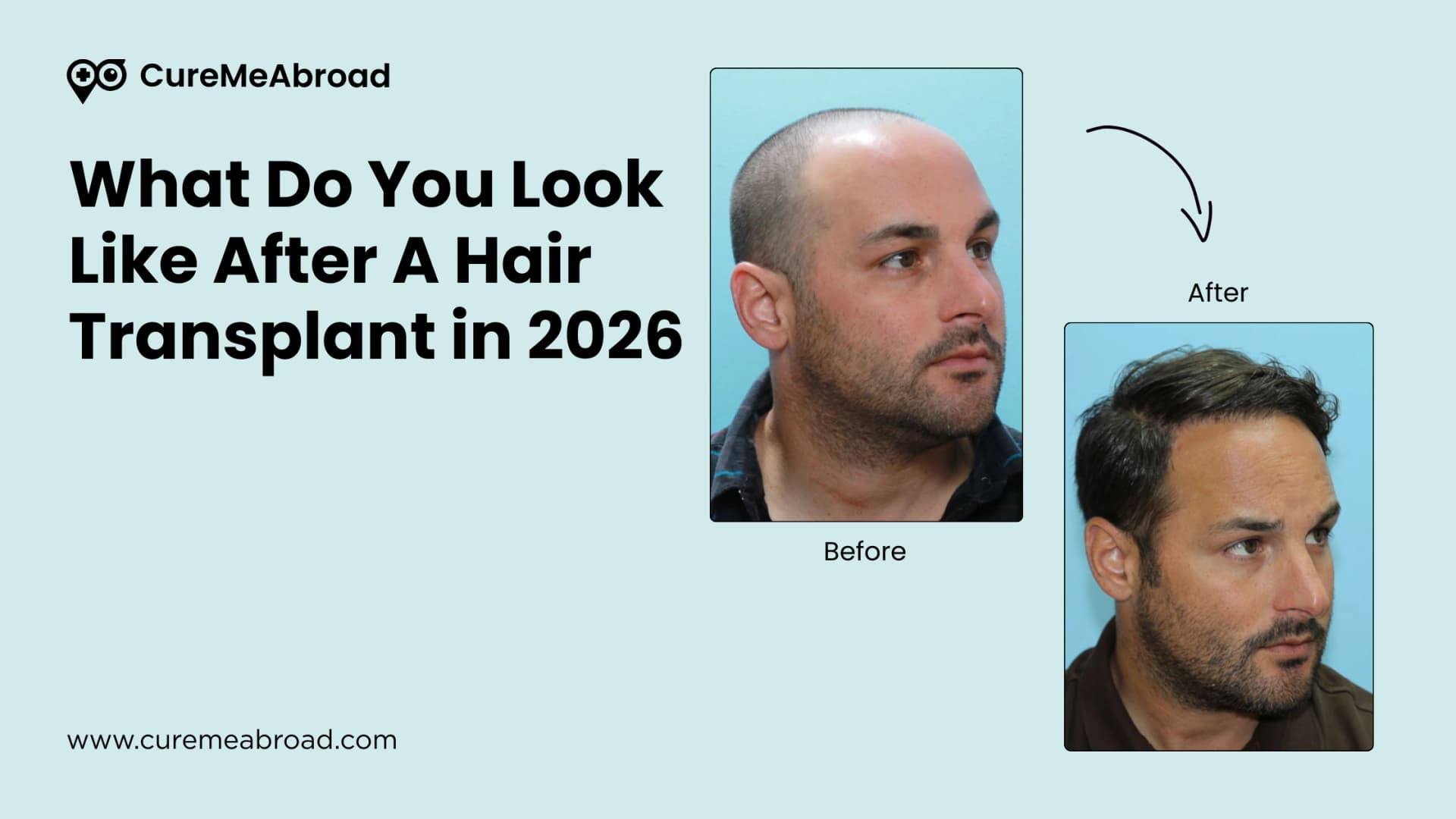 What Do You Look Like After A Hair Transplant in 2026: Before And After